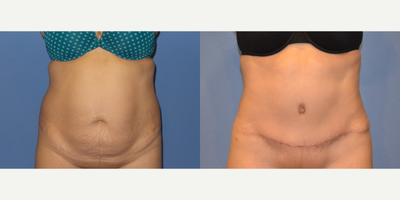 Case 2023 - 45-54 year old woman treated with Tummy Tuck