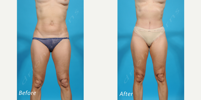 Case 2025 - 45-54 year old woman treated with Tummy Tuck