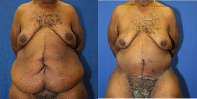 Case 2027 - 65-74 year old man treated with Tummy Tuck