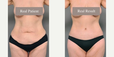 Case 2028 - 35-44 year old woman treated with Tummy Tuck