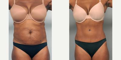 Case 2029 - 35-44 year old woman treated with Tummy Tuck
