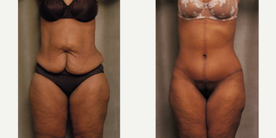 Case 2030 - 35-44 year old woman treated with Tummy Tuck