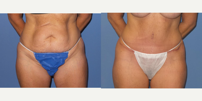 Case 2031 - 45-54 year old woman treated with Tummy Tuck