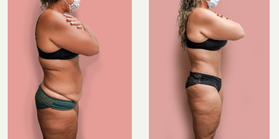 Case 2032 - 35-44 year old woman treated with Tummy Tuck