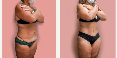 Case 2033 - 35-44 year old woman treated with Tummy Tuck