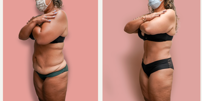 Case 2034 - 35-44 year old woman treated with Tummy Tuck