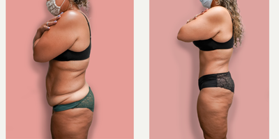 Case 2035 - 35-44 year old woman treated with Tummy Tuck