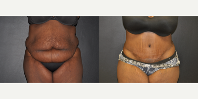 Case 2036 - 46 year old woman treated with Extended Tummy Tuck with Internal Corset