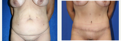 Case 2037 - 45-54 year old woman treated with Tummy Tuck