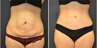 Case 2038 - 32 year old mother treated with Tummy Tuck