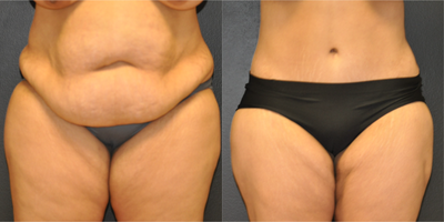 Case 2039 - 37 year old woman treated with Extended Tummy Tuck with Pubic Lift (front view)
