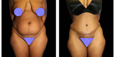 Case 204 - 25-34 year old woman treated with Tummy Tuck