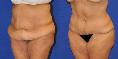 Case 2040 - Tummy Tuck