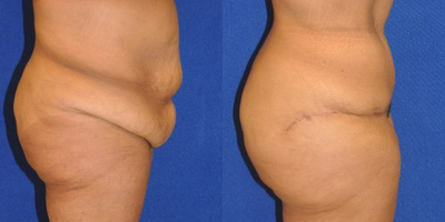 Case 2041 - Tummy Tuck
