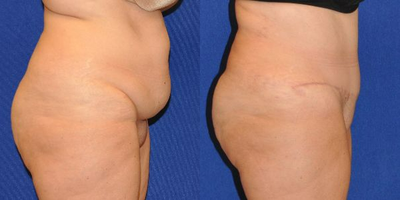 Case 2042 - Tummy Tuck