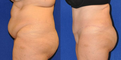 Case 2043 - Tummy Tuck