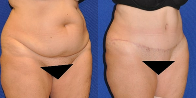 Case 2044 - Tummy Tuck