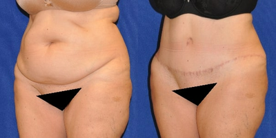 Case 2045 - Tummy Tuck