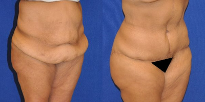 Case 2046 - Tummy Tuck