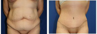 Case 2047 - 35-44 year old woman treated with Tummy Tuck