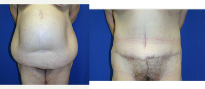 Case 2048 - 55-64 year old woman treated with Tummy Tuck