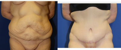 Case 2049 - 25-34 year old woman treated with Tummy Tuck