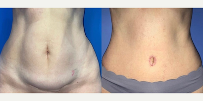 Case 205 - Woman treated with Tummy Tuck
