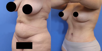 Case 2054 - Woman treated with Mommy Makeover, Breast Lift, Tummy Tuck