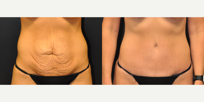 Case 2056 - 34 year old woman treated with Tummy Tuck