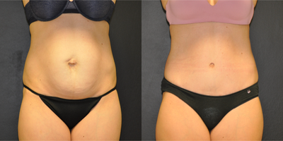 Case 2058 - 36 year old woman treated with Tummy Tuck and Hernia Repair