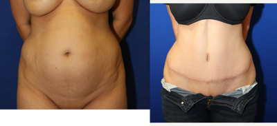 Case 2059 - 35-44 year old woman treated with Tummy Tuck
