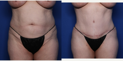 Case 206 - 55-64 year old woman treated with Tummy Tuck