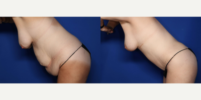 Case 2060 - 43 year old woman treated with Breast Lift, Tummy Tuck, Liposuction, Mommy Makeover