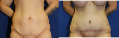 Case 2061 - 25-34 year old woman treated with Tummy Tuck