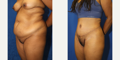 Case 2062 - 35-44 year old woman treated with Tummy Tuck
