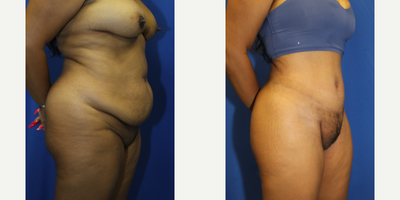 Case 2063 - 35-44 year old woman treated with Tummy Tuck