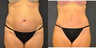 Case 2064 - 48 year old woman treated with Tummy Tuck with Internal Corset