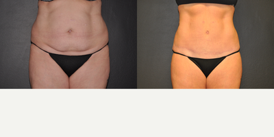 Case 2065 - 45 year old woman treated with Tummy Tuck (front view)