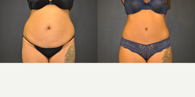 Case 2066 - 38 year old woman treated with Tummy Tuck (front view)