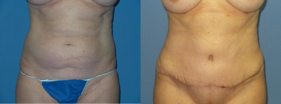 Case 2067 - 50 year old woman treated with Tummy Tuck