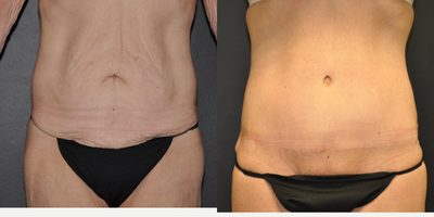 Case 2068 - 55 old woman treated with Extended Tummy Tuck