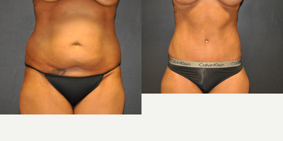 Case 2069 - 25-34 year old man treated with Tummy Tuck