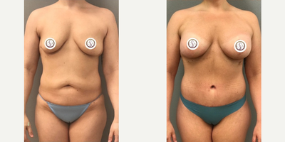 Case 207 - Woman treated with Breast Augmentation, Tummy Tuck