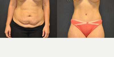 Case 2070 - 30 year old woman treated with Tummy Tuck