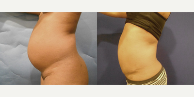 Case 2072 - 45 year old woman treated with Tummy Tuck
