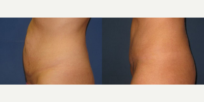 Case 2074 - Woman treated with Mini Tummy Tuck