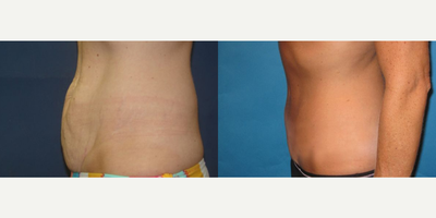 Case 2075 - 47 year old woman treated with Tummy Tuck
