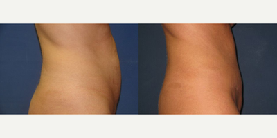 Case 2076 - Woman treated with Mini Tummy Tuck