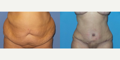 Case 2078 - 55 year old woman treated with Tummy Tuck