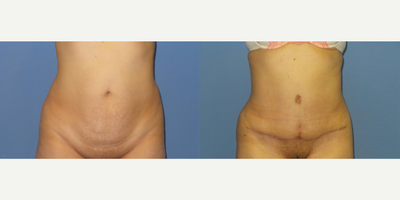 Case 2079 - 52 year old woman treated with Tummy Tuck